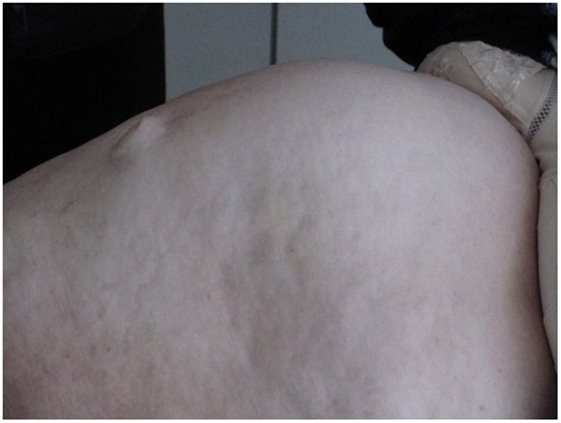 Blooming Bulges: Exploring the Enigmatic Phenomenon of 'Bulging'